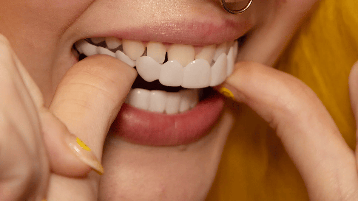 Snap-On Smile Veneers – Herbruikbare Tanden Facings voor een Stralende Glimlach zonder Tandarts