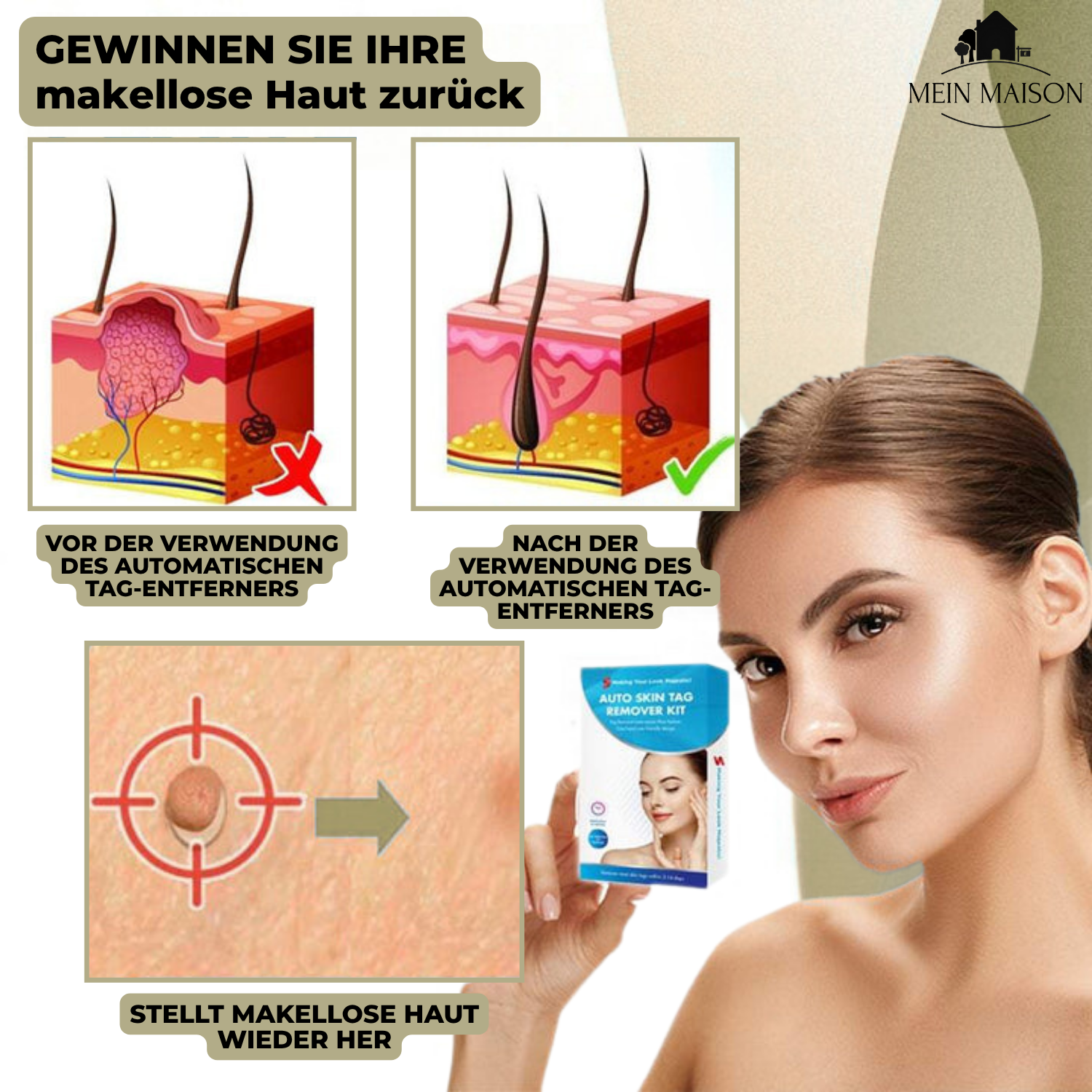 DermaLinx Wrattenverwijderaar | Pijnloze Verwijdering van Wratten & Moedervlekken | Voor Thuis | Zonder Operatie